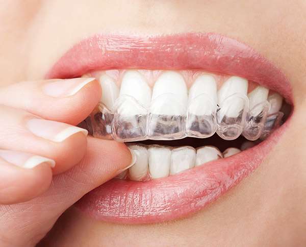 Get Help Choosing Between Invisalign And Braces To Straighten Teeth