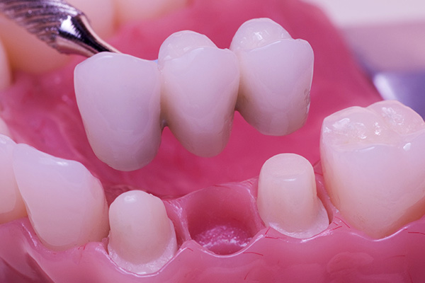 Dental Options For Replacing Missing Teeth
