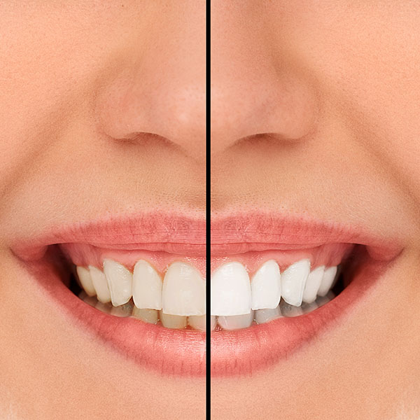 A Cosmetic Dentist Can Give You Long Lasting Veneers
